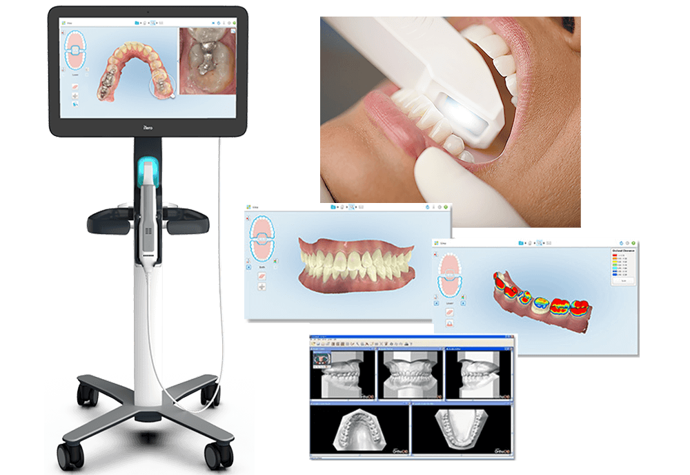 口腔内光学スキャナ iTero(アイテロ)